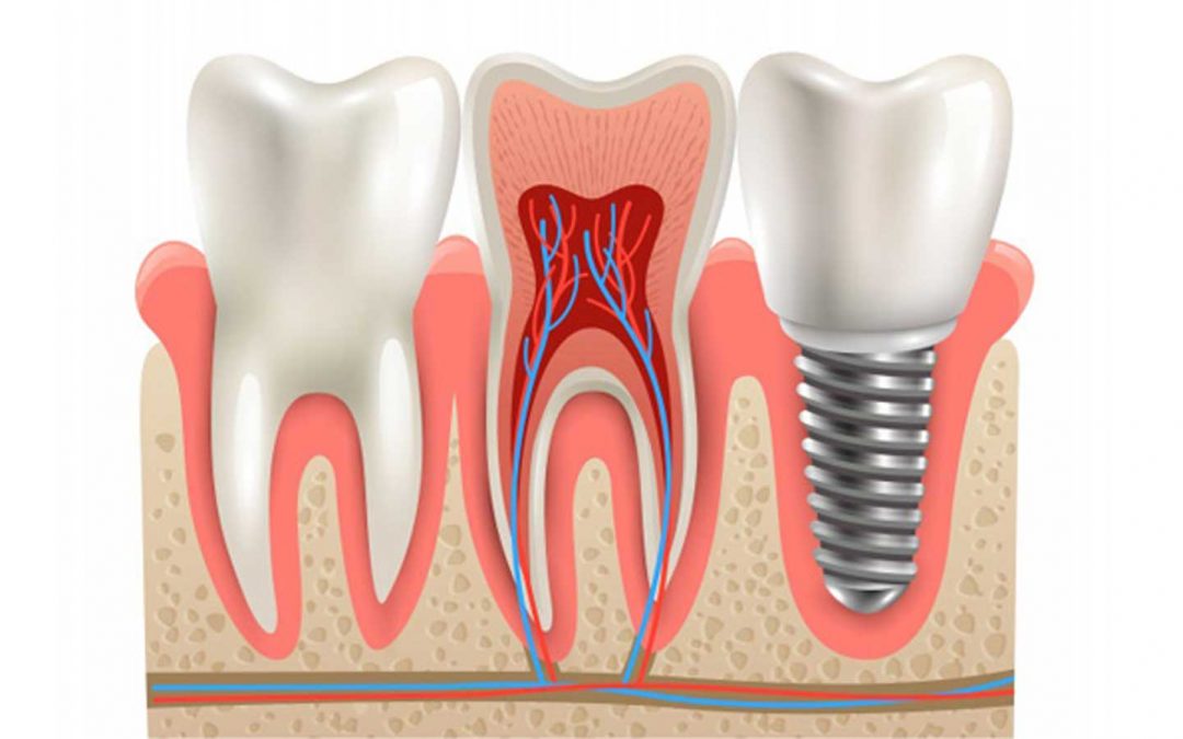 Time To Consider Same Day Dental Implants