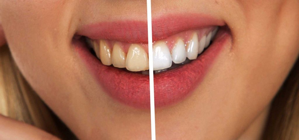 Before After Yellow Teeth | Dental Treatment