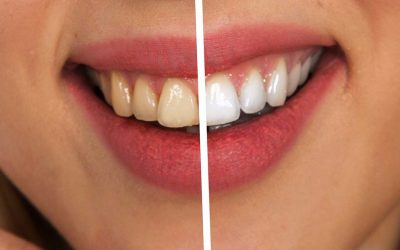 Tooth Sensitivity And Whitening Options