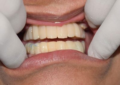 In Virtually No Bone, Get Dental Implants In 1 Day