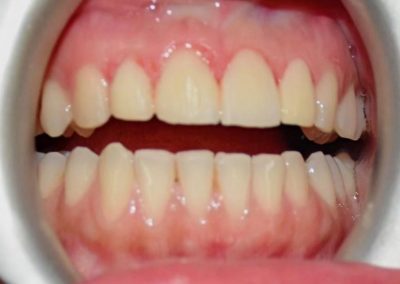 Cosmetic Contouring Of Teeth Within Few Hours