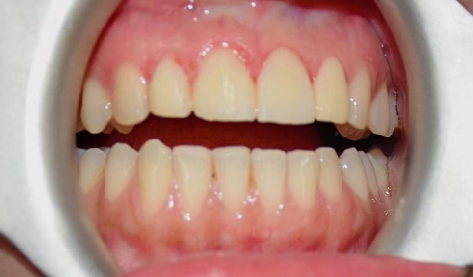 Cosmetic Contouring Of Teeth Within Few Hours