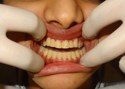 Best Alternate To Braces For Fixing Crooked Teeth