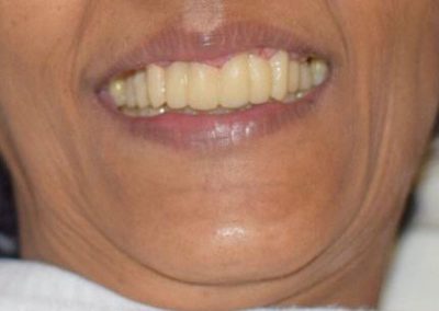 Restoration Of Mobile, Missing Or Misaligned Teeth