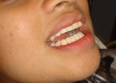 Cosmetic Correction For Protruding Teeth In Few Hours