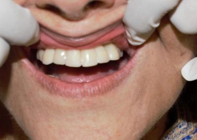 Replace Missing Teeth With Implants In One Day