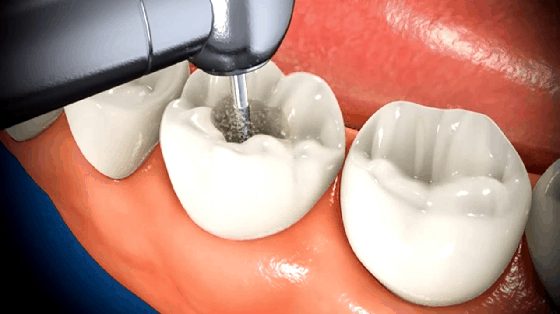 Root canal treatment cost in India - India Dental Tourism