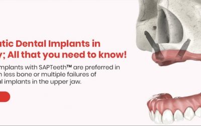 Zygomatic dental implants with SAPTeeth™