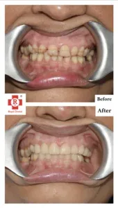 Bite-Alignment-Before-After
