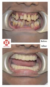 Implant for Moving Teeth