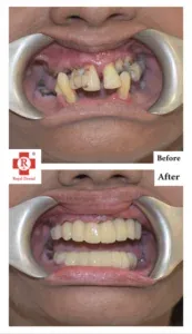Implant for Tooth Mobility