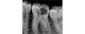 ROOT CANALS