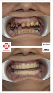 Root canal after treatment