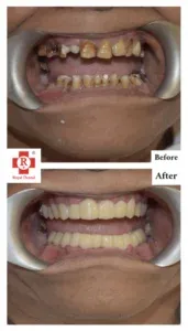 Root canal before treatment