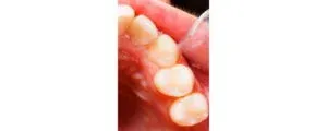 TOOTH After Treatment