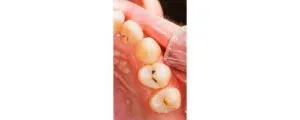 TOOTH Before Treatment