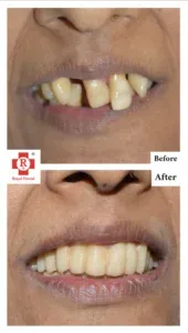 Tooth-Mobility-Before-After-Trea