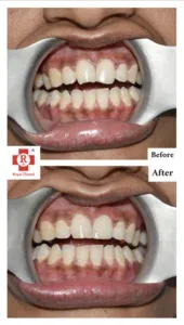 before-After-Filling-and-Root-Canal