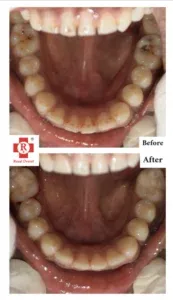 best Root canal before treatment