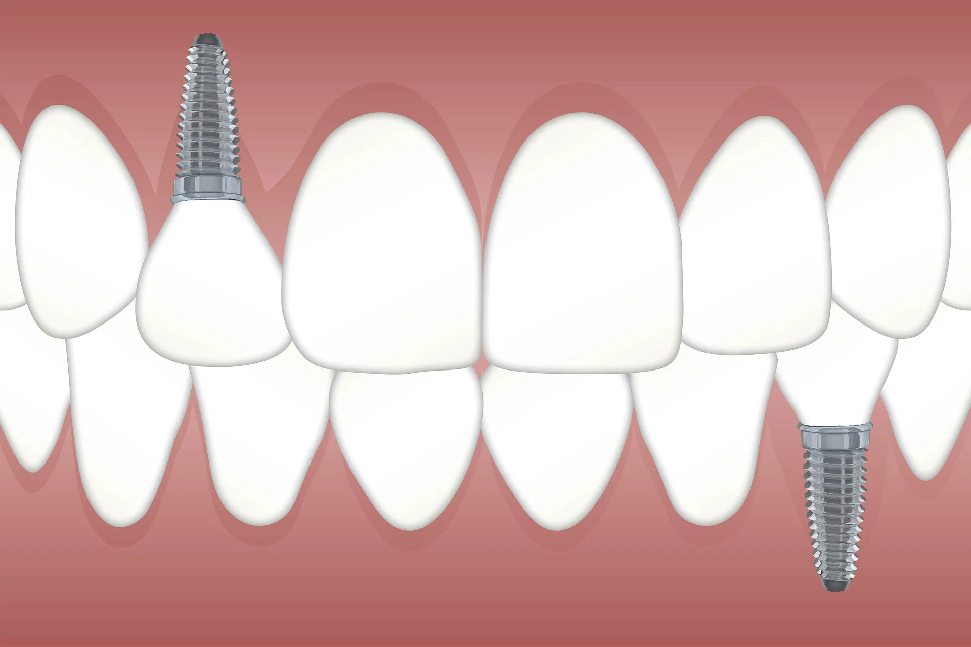 teeth-dentalimplant