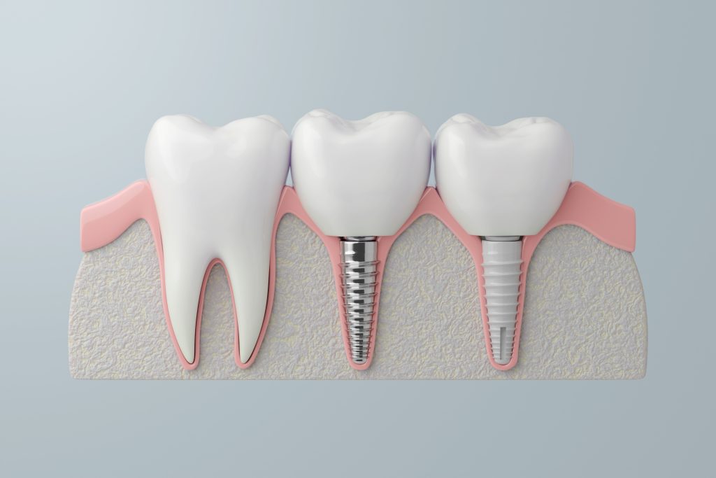 Same Day Dental Implants in India