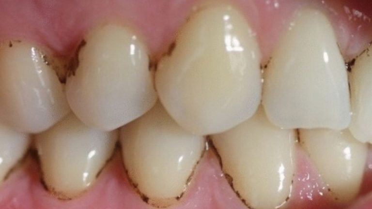 Dark Black Line On Tooth | Cavity, Filling, Plaque