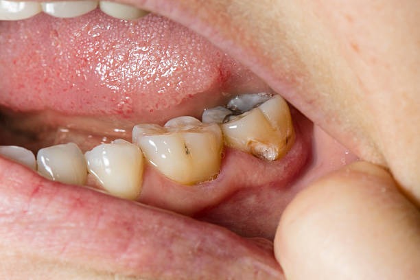 Dental treatment for third molar cavity