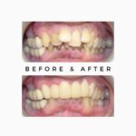 Smile Beautification in India