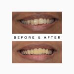 Cosmetic Dentistry in India