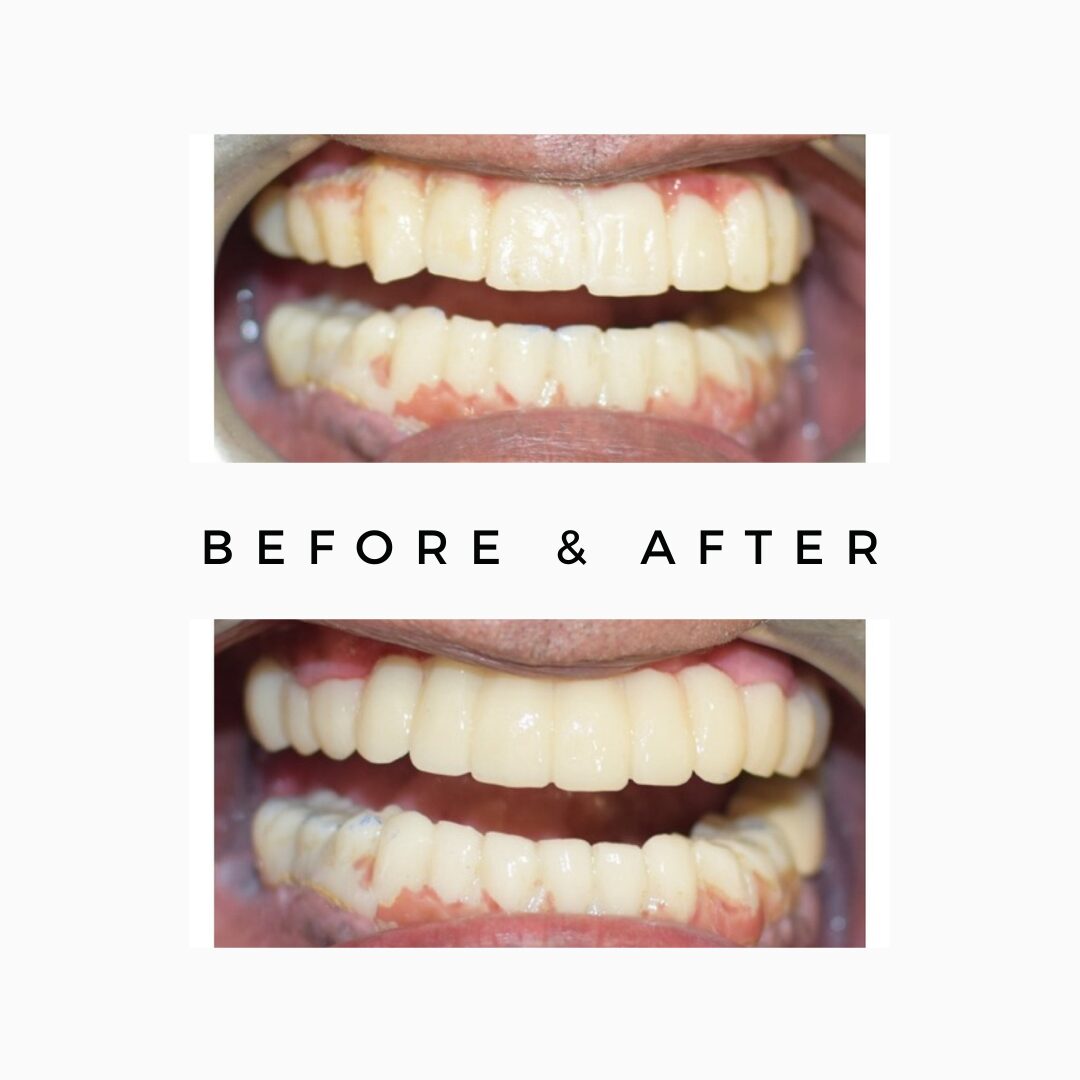 Price of Dental Treatment in India