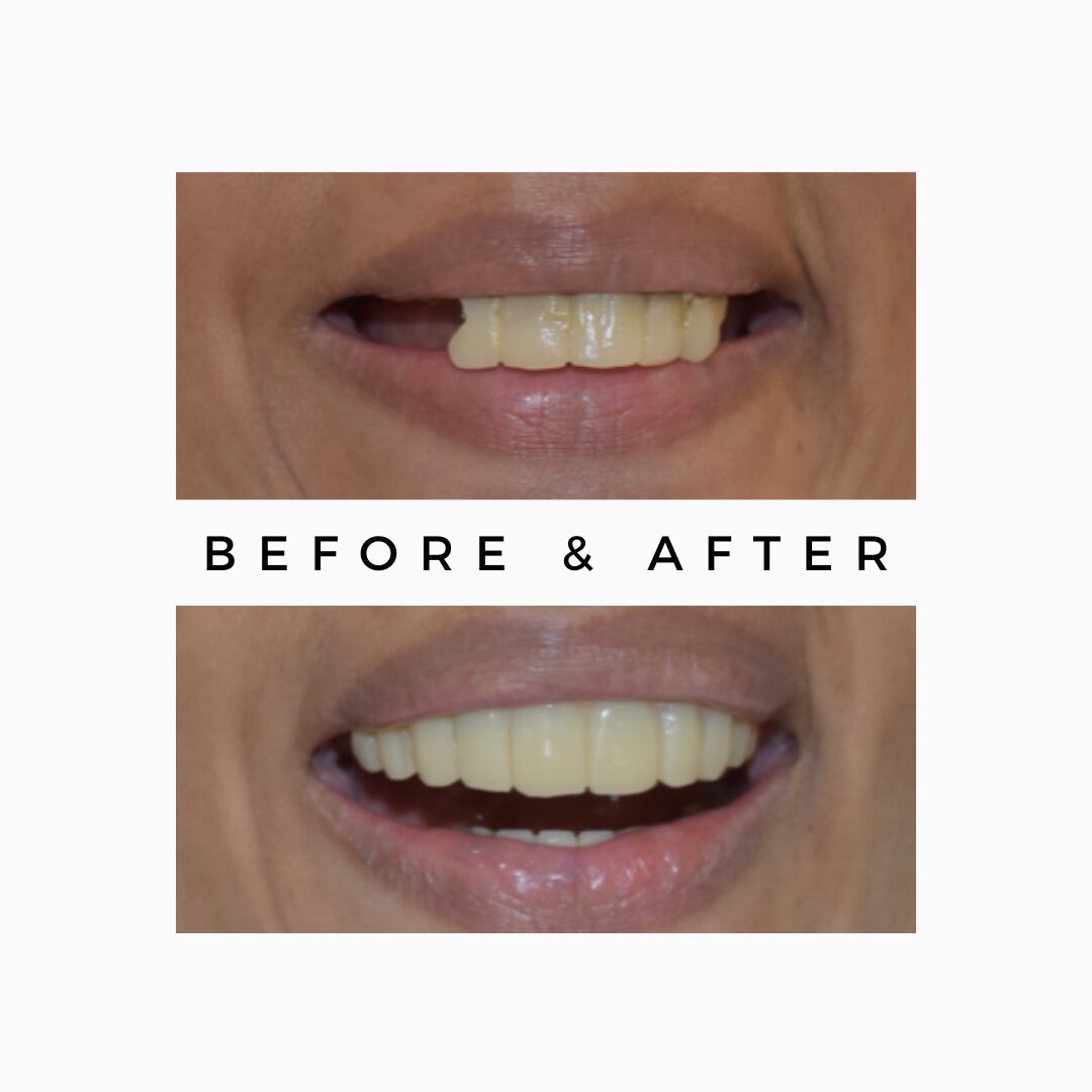 Missing Teeth Replacements