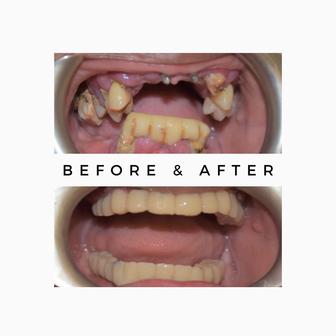 No Teeth toFixed Teeth in One Day