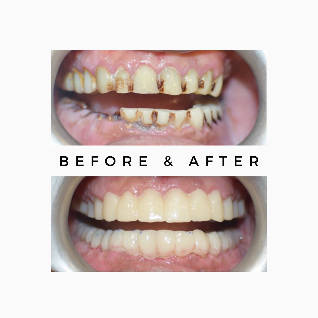 Teteh Stains - Paan Habit