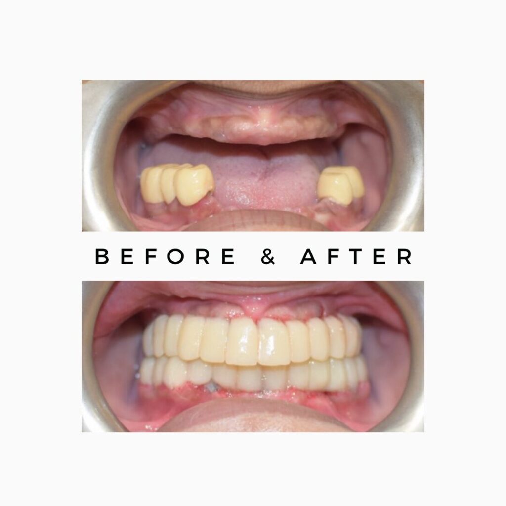 Dental implant surgery in India with digital planning