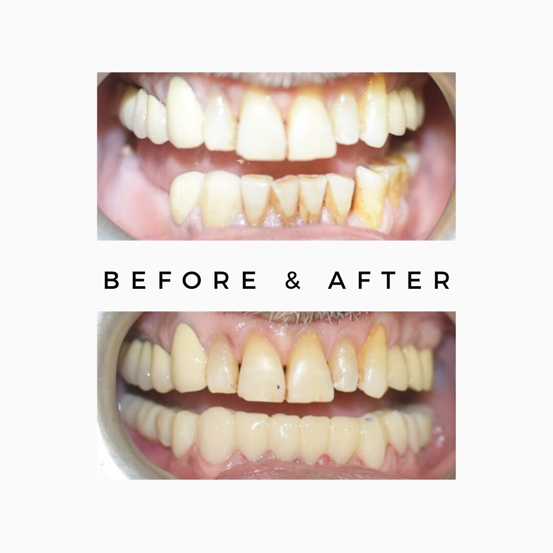 Full mouth rehabilitation results India
