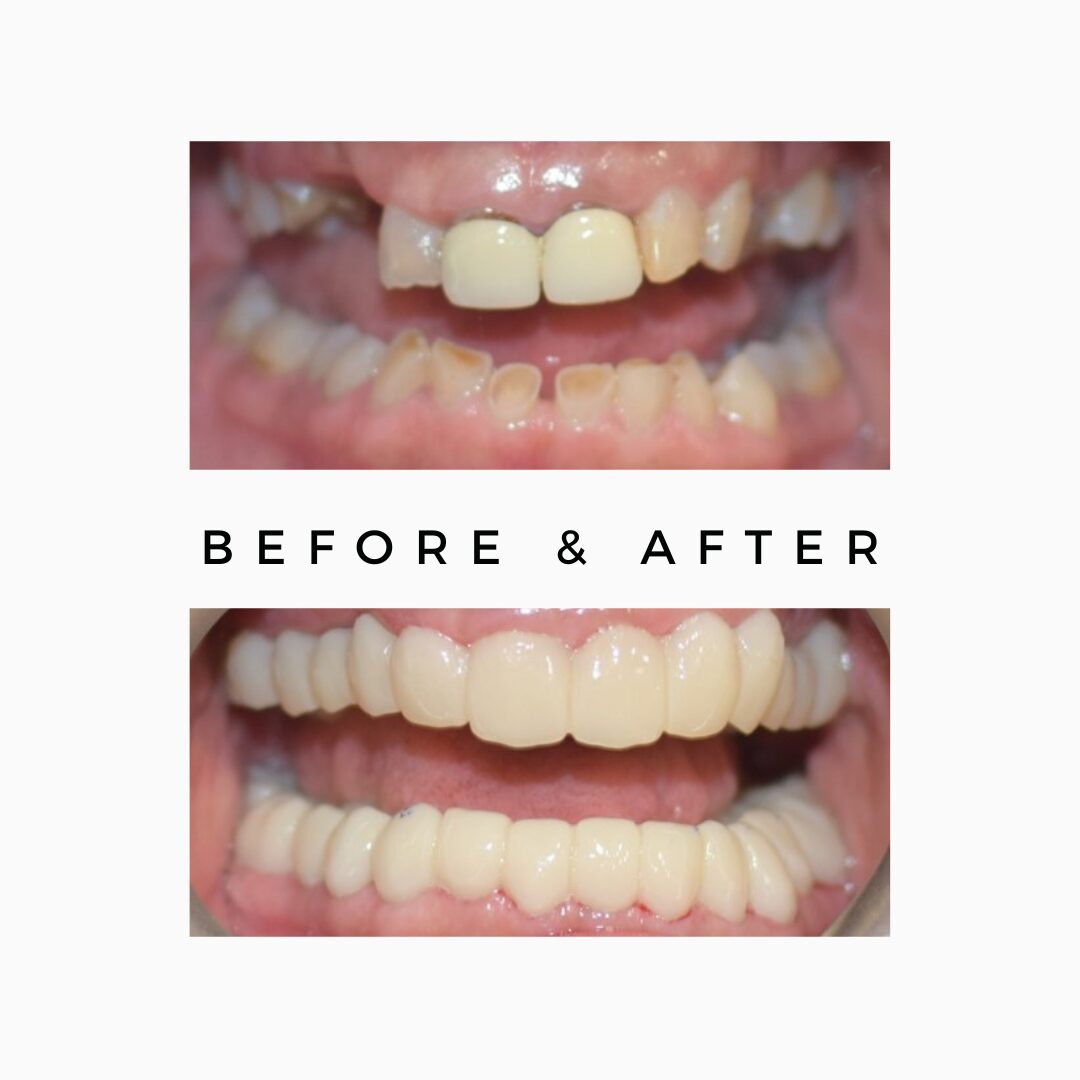 Fixed teeth in one day dental implants India