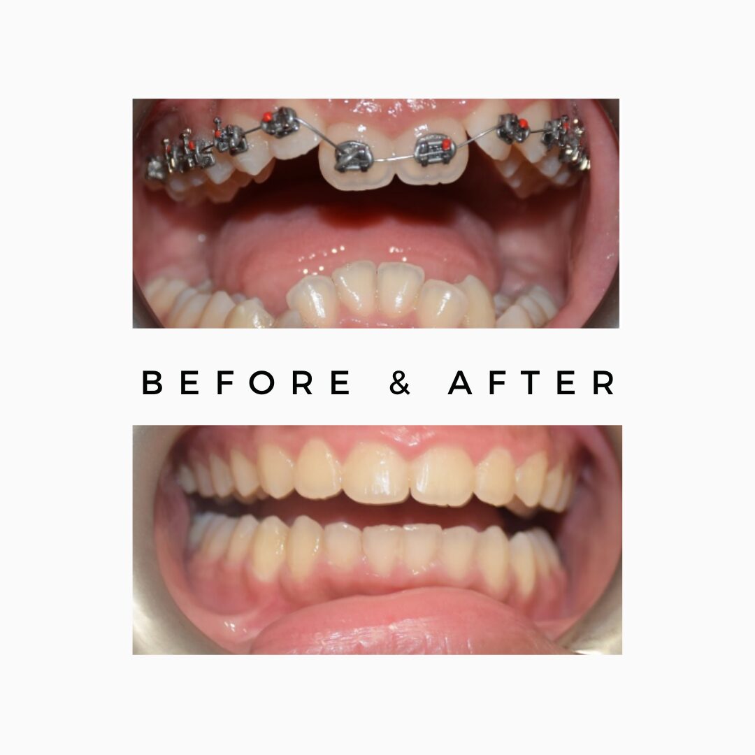 Braces Smile makeover treatment in India