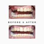 Missing Teeth Treatment