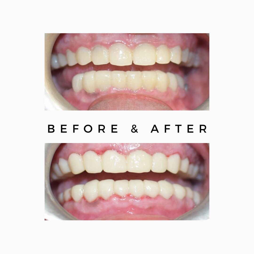 Natural smile design cosmetic dentistry India in One Day