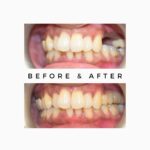 Posterior missing teeth replacement