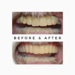 Upper Lower Dentures cost in India