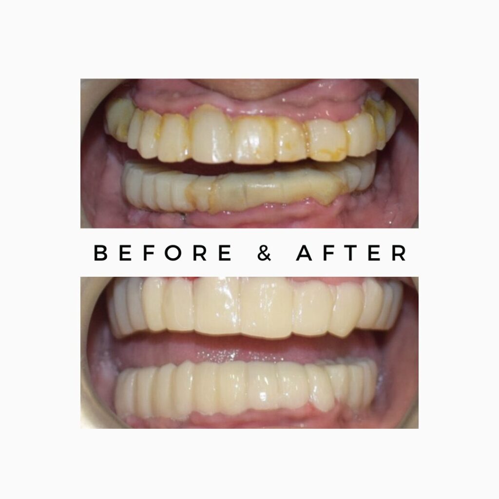 Full Mouth Makeover Cost