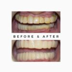 Full Mouth Makeover Cost