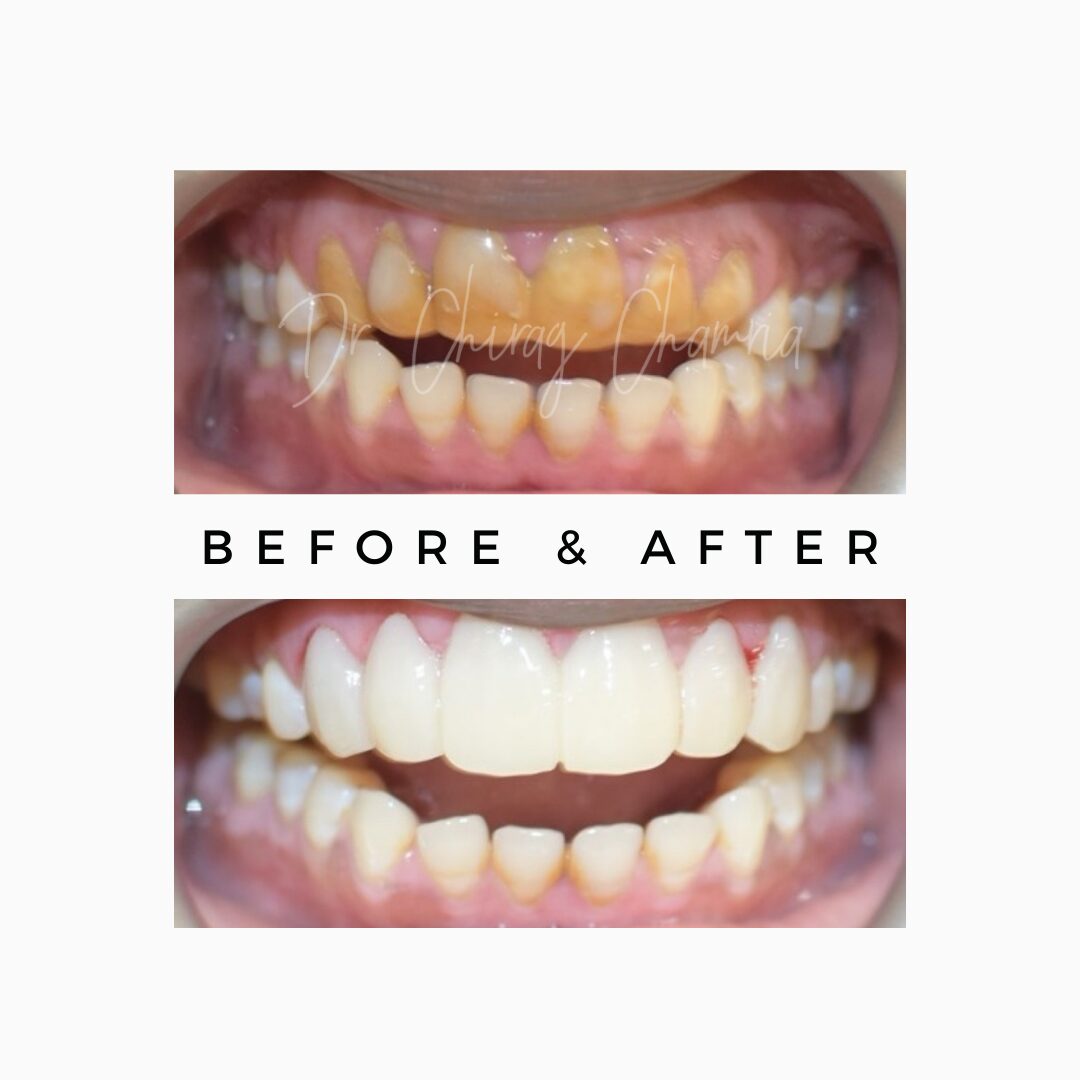 Cost of Smile Makeover for Front Teeth