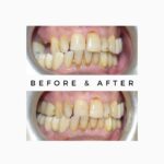 Teeth Staining : Teeth whitening treatment in India