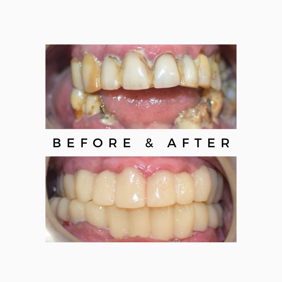 Full Mouth Root Canal Treatment in One Day