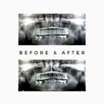 Wisdom Tooth Pain - Extraction