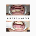 Dental implant unless or no bone '