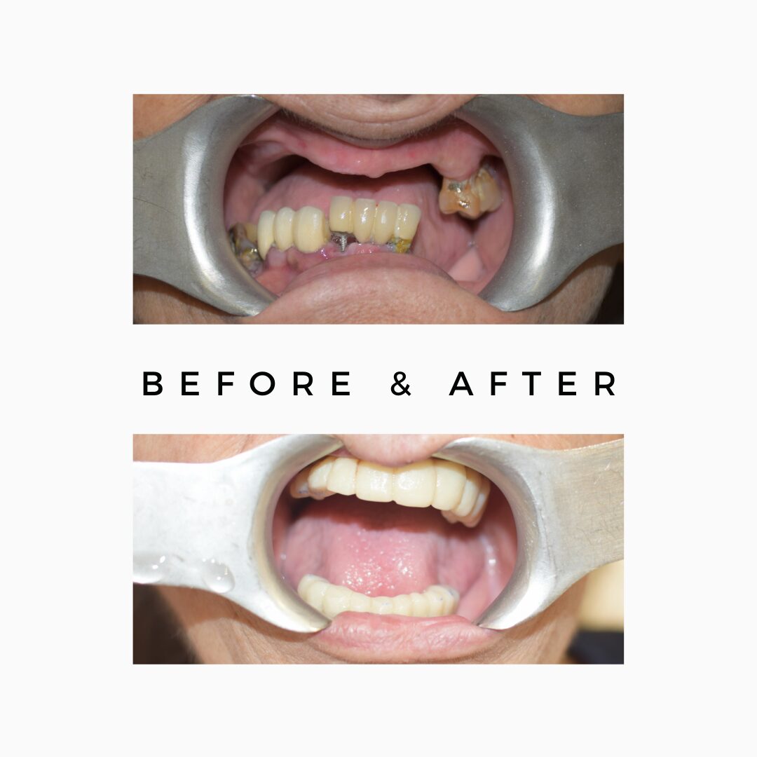 Dental implant unless or no bone '